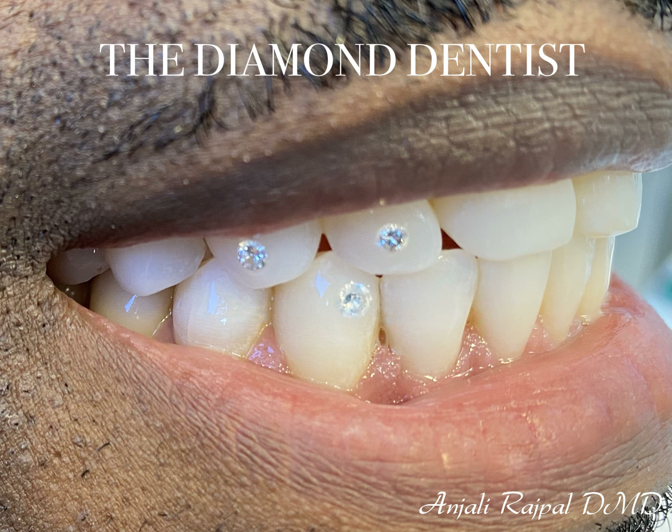 diamond dental teeth implants